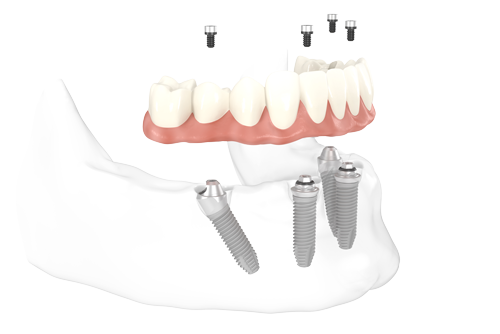 4. Feste Zähne an einem Tag – dauerhaft